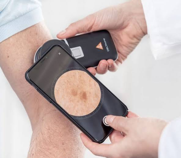 HEINE DELTAone Dermatoskop mit Smartphone-Aufsatz bei der Hautuntersuchung